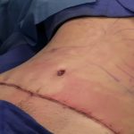 How Much Does Men’s Liposuction Cost