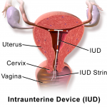 How Much Does an IUD Cost